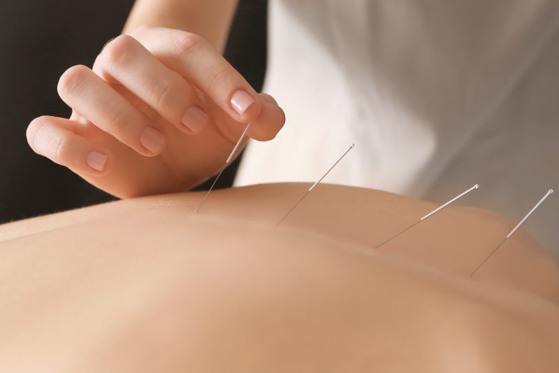 Medical Acupuncture, Acupuncture, Acupuncture Therapy