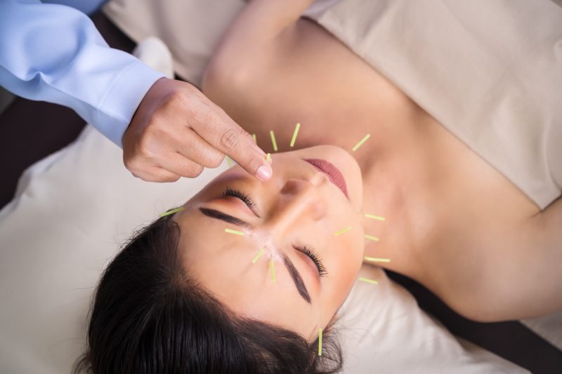 Cosmetic Acupuncture, Facial Acupuncture, Facial Rejuvenation Acupuncture